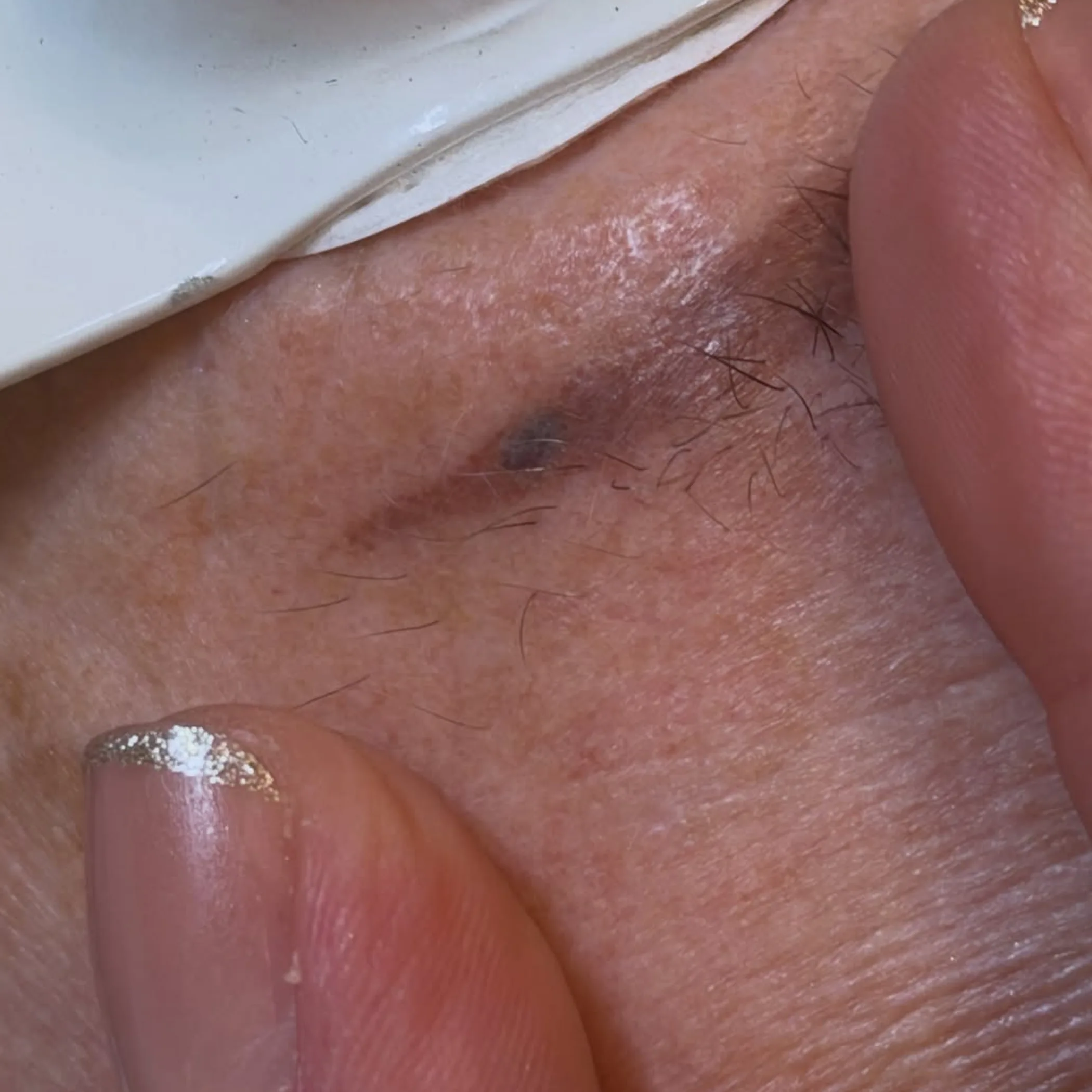 darkened cosmetic tattoo pigment response