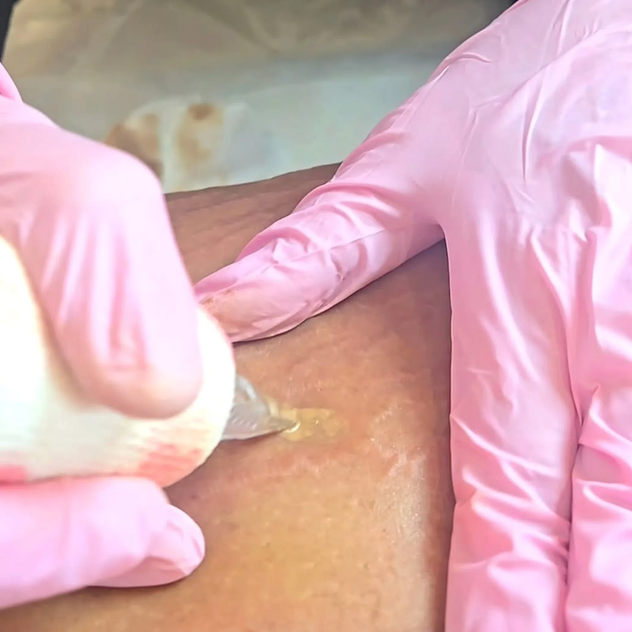 gloved practitioner tattooing skin