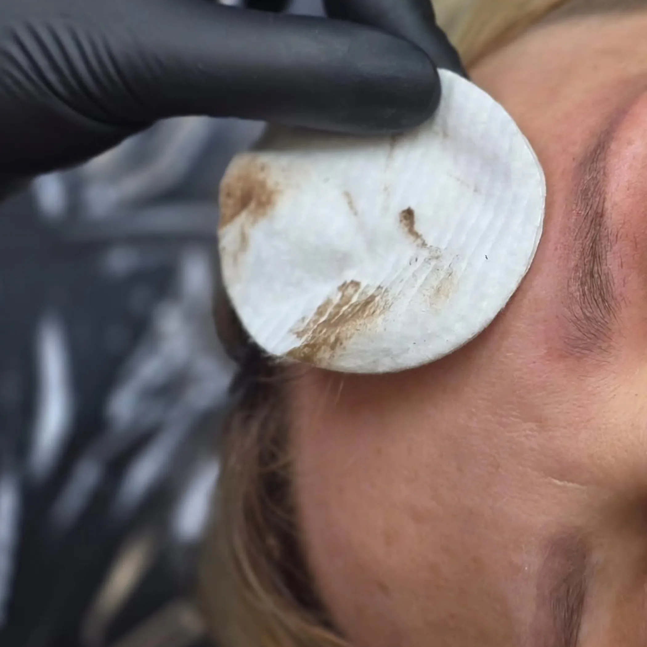 cosmetic eyebrow tattoo removal procedure