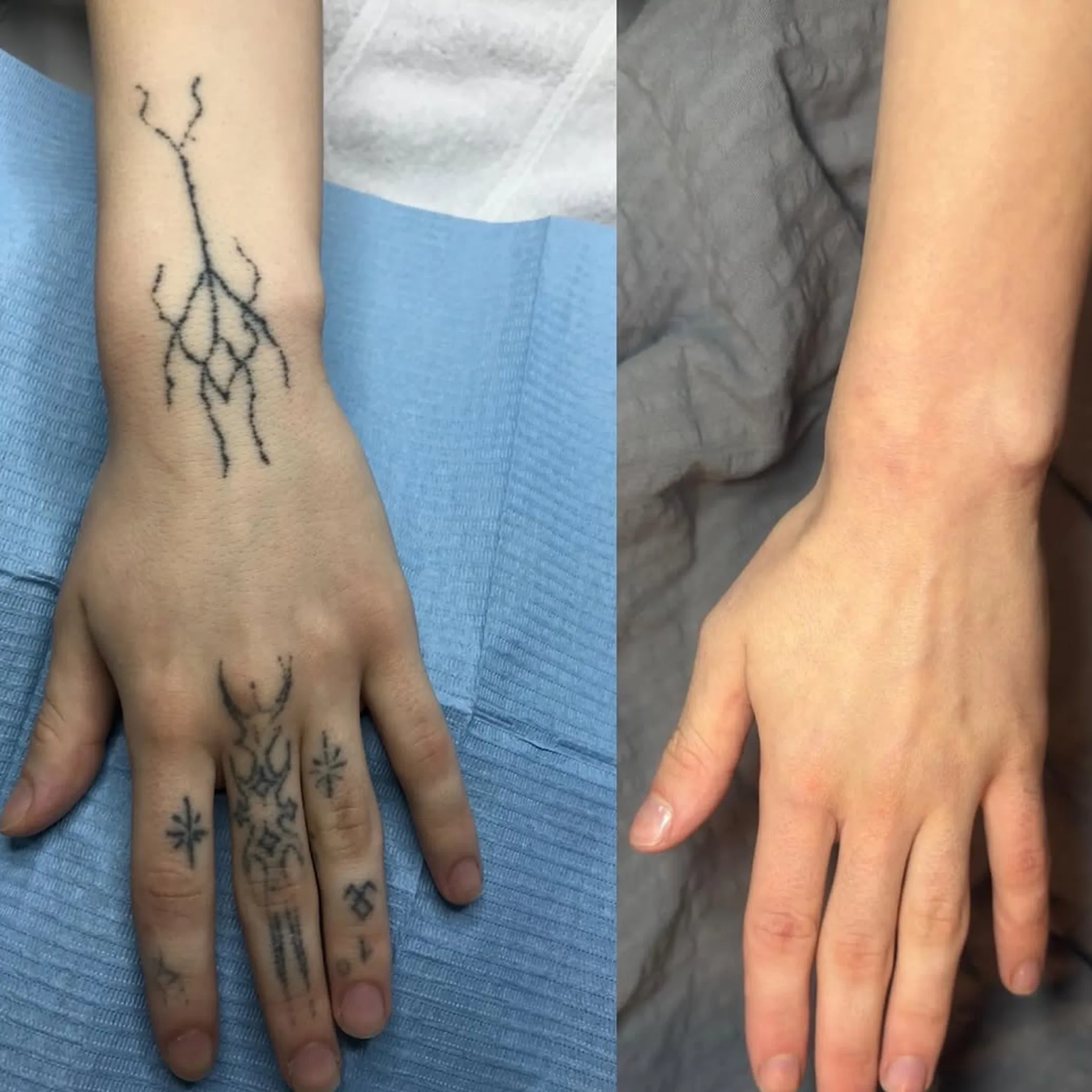 tattoo removal progress before after